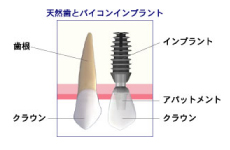 インプラント図解